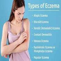 remedies-for-eczema-allergies